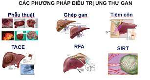Cách điều trị ung thư gan