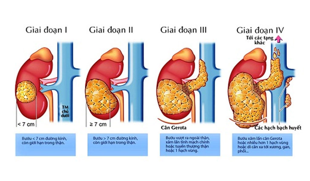 Giai đoạn ung thư gan